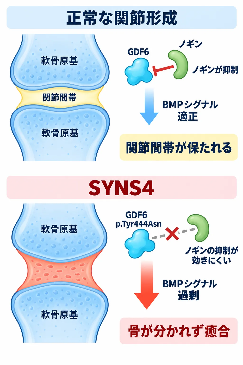GDF6変異によりSYNS4の骨癒合が起こる仕組み 正常ではノギンがGDF6を抑制して関節間帯が保たれ、SYNS4ではGDF6 p.Tyr444AsnによりBMPシグナルが過剰となって骨が癒合する仕組み
