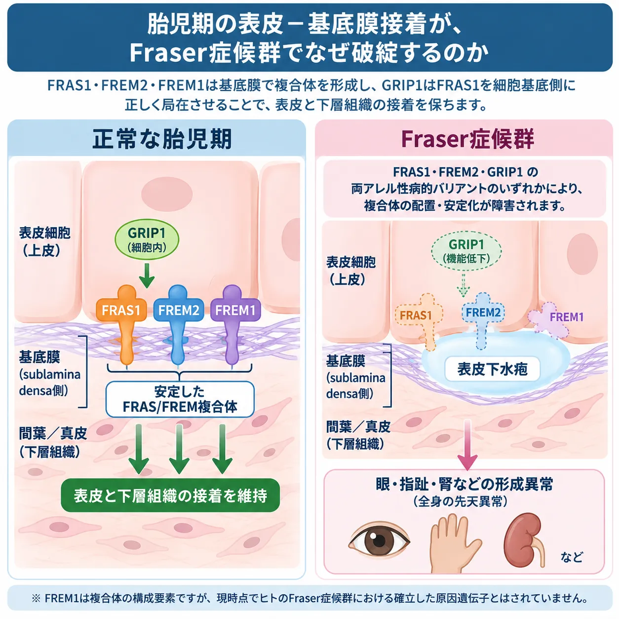 正常な胎児期ではFRAS1・FREM2・FREM1からなるFRAS/FREM複合体とGRIP1が表皮と基底膜・下層組織の接着を維持する一方、Fraser症候群ではFRAS1・FREM2・GRIP1の両アレル性病的バリアントにより接着が障害され、表皮下水疱と眼・指趾・腎などの形成異常につながる仕組みを比較した模式図