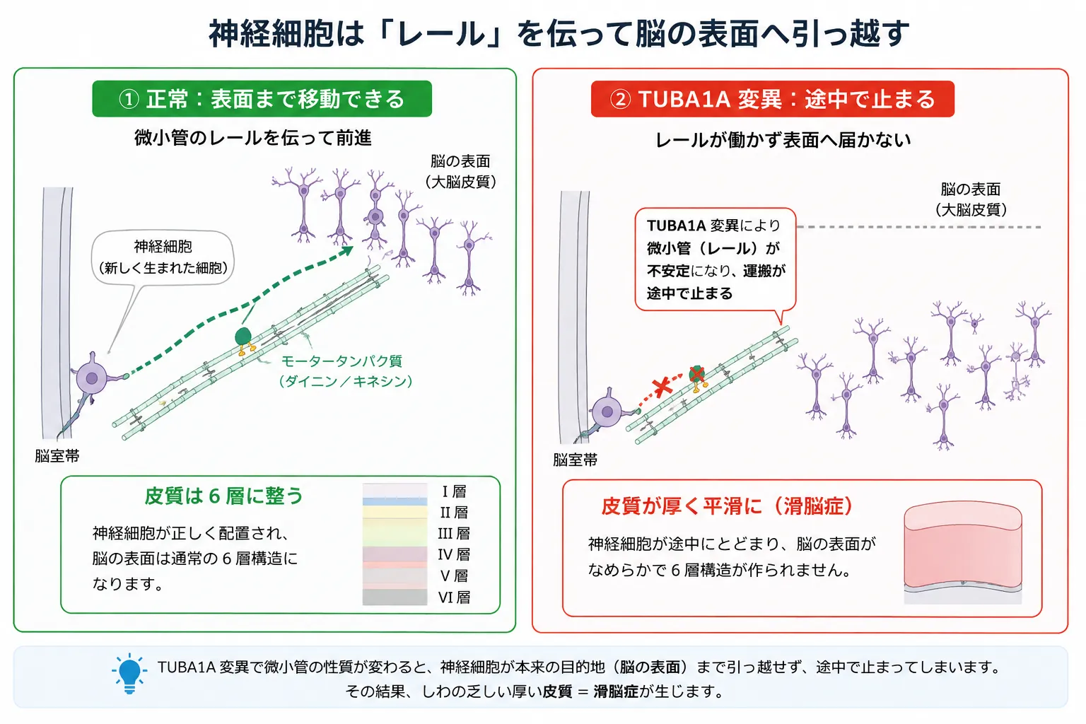 正常では神経細胞が微小管を利用して脳室帯から大脳皮質表面へ移動し6層構造を形成するが、TUBA1A変異では微小管機能が障害され神経細胞が途中で停止し、厚く平滑な大脳皮質を呈する滑脳症が生じる仕組みを示した模式図。