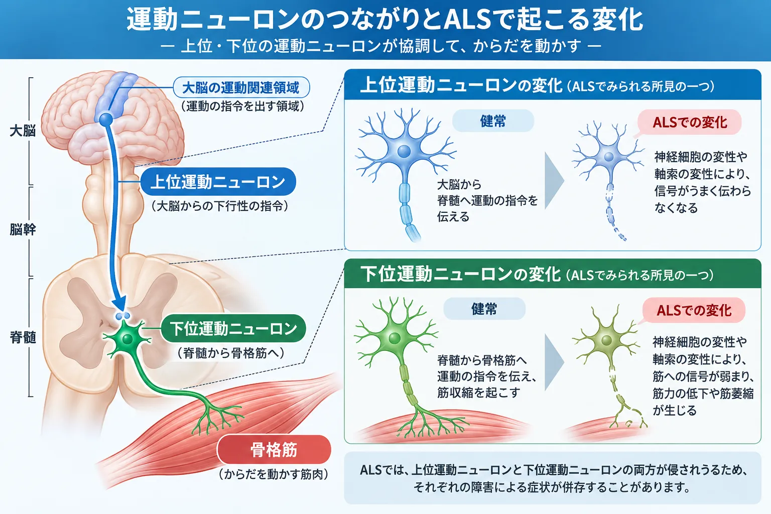 大脳から脊髄へ指令を送る上位運動ニューロンと、脊髄から骨格筋へ指令を伝える下位運動ニューロンの位置関係、およびALSで両者が障害されうることを示した模式図