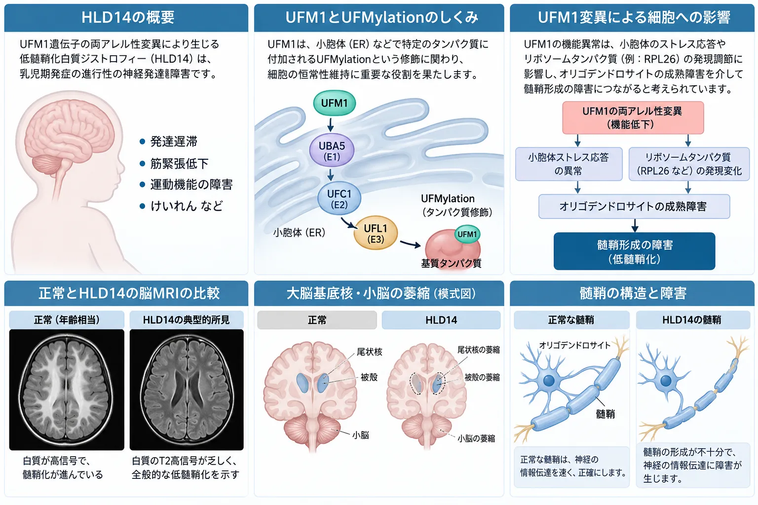 HLD14(低髄鞘化白質ジストロフィー14型)の病態を示す医学イラスト。UFM1遺伝子変異とUFMylation、小胞体・リボソームへの影響、低髄鞘化、被殻・尾状核・小脳の萎縮、正常脳とHLD14のMRI所見を比較