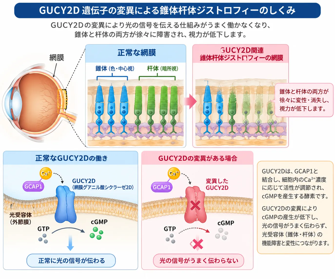 GUCY2D遺伝子の変異により網膜グアニル酸シクラーゼの機能が変化し、cGMPを介した視細胞の光応答が障害されて錐体杆体ジストロフィーを生じる仕組みを示した模式図