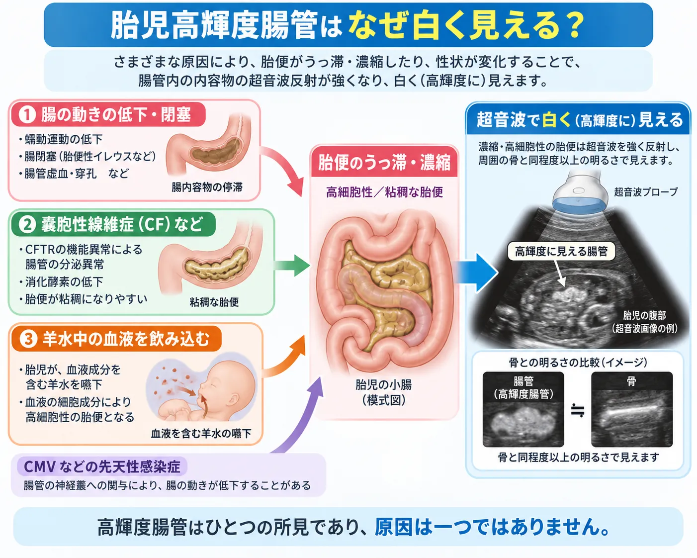 胎児高輝度腸管が超音波で白く見える仕組み 胎児高輝度腸管で、腸の動きの低下や閉塞、嚢胞性線維症、羊水中の血液の嚥下、先天性感染などにより胎便がうっ滞・濃縮し、超音波で骨と同程度以上に白く見える仕組みを示した模式図