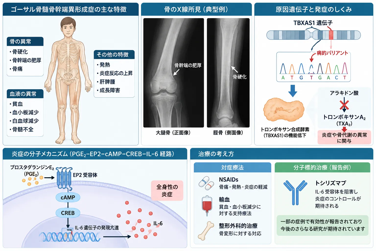Ghosal型血液骨幹異形成症(GHDD)の骨硬化・貧血などの特徴、TBXAS1遺伝子異常、PGE2–EP2–cAMP–CREB–IL-6炎症経路と治療の考え方を示す医学図
