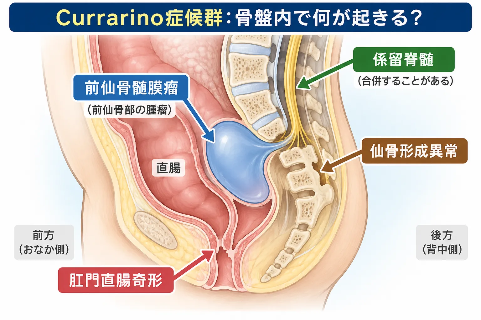 Currarino症候群でみられる仙骨形成異常、肛門直腸奇形、前仙骨髄膜瘤の位置関係と、係留脊髄を合併することがあることを骨盤の矢状断で示した模式図