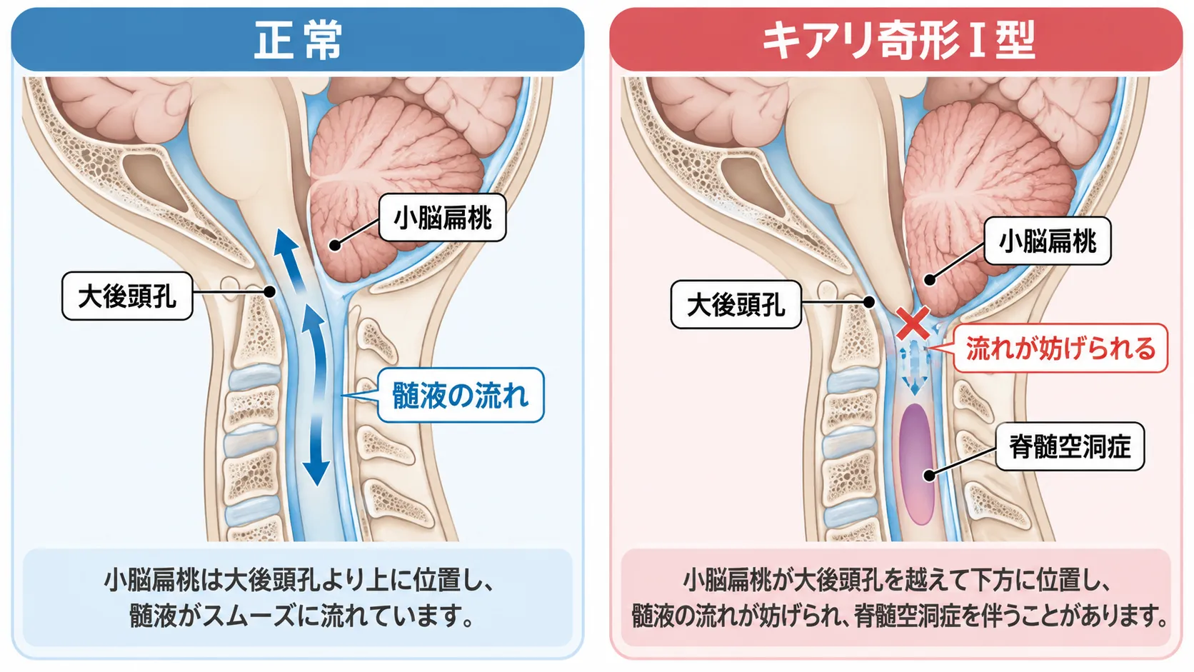 正常では小脳扁桃が大後頭孔より上に位置して髄液が流れるのに対し、キアリ奇形I型では小脳扁桃が大後頭孔を越えて下降し、髄液の流れが妨げられて脊髄空洞症を伴うことがある仕組みを比較した模式図