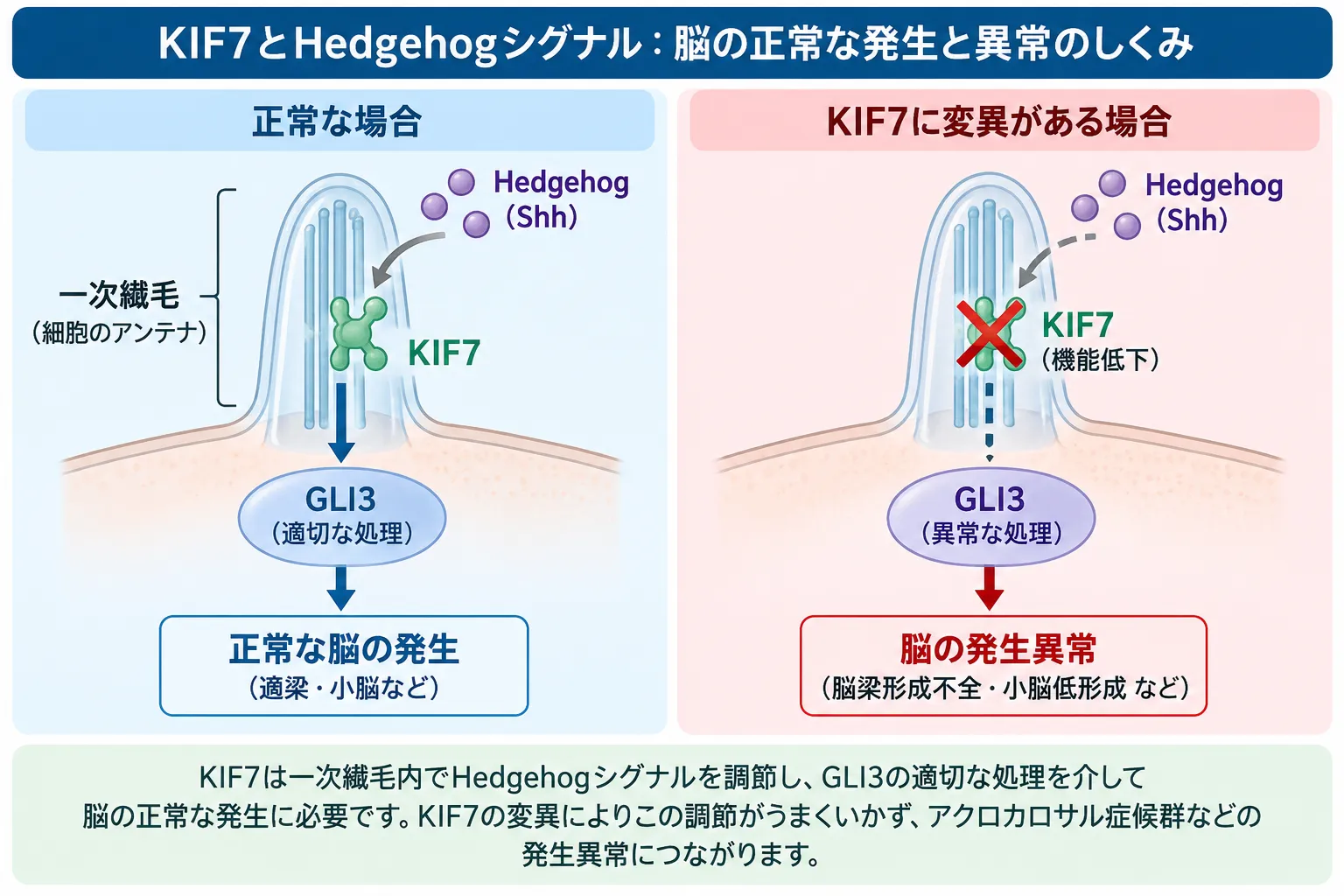 KIF7が一次線毛でHedgehogシグナルとGLI3の処理を調節する正常な状態と、KIF7機能低下によりGLI3の処理が乱れ、脳梁形成不全や小脳低形成などの脳発生異常につながる仕組みを比較した模式図