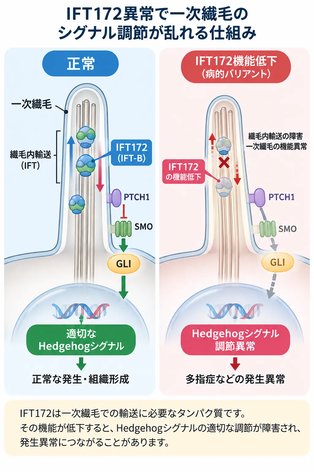 正常な一次繊毛ではIFT172を含むIFT-B複合体による繊毛内輸送がHedgehogシグナルの適切な調節を支える一方、IFT172の機能低下では繊毛内輸送とHedgehogシグナル調節が障害され、多指症などの発生異常につながる仕組みを比較した模式図