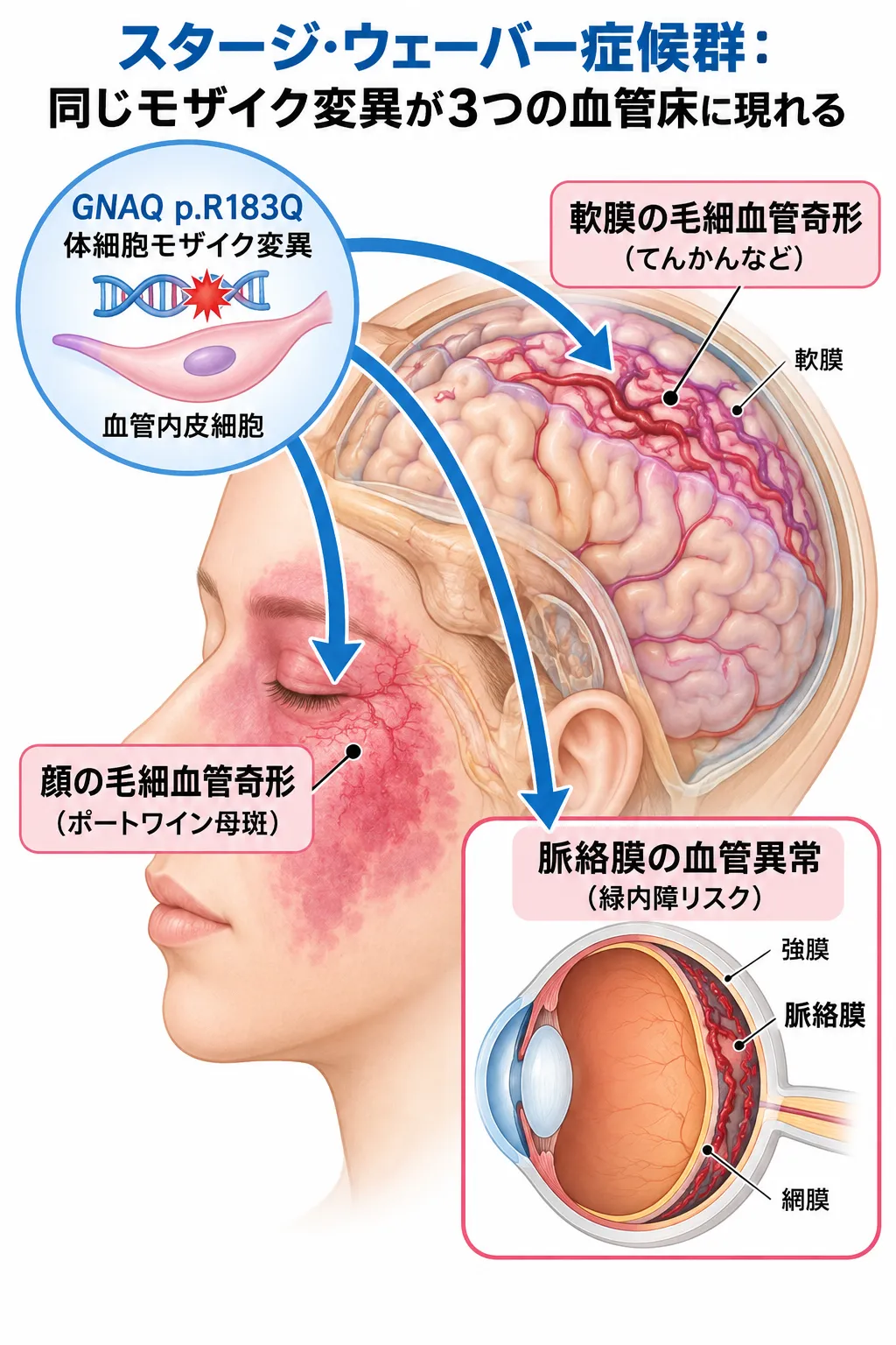 GNAQ p.R183Q体細胞モザイク変異をもつ血管内皮細胞が、顔の毛細血管奇形(ポートワイン母斑)、脳軟膜の毛細血管奇形、脈絡膜の血管異常として現れ、スタージ・ウェーバー症候群の皮膚・脳・眼の症状につながる位置関係を示した模式図