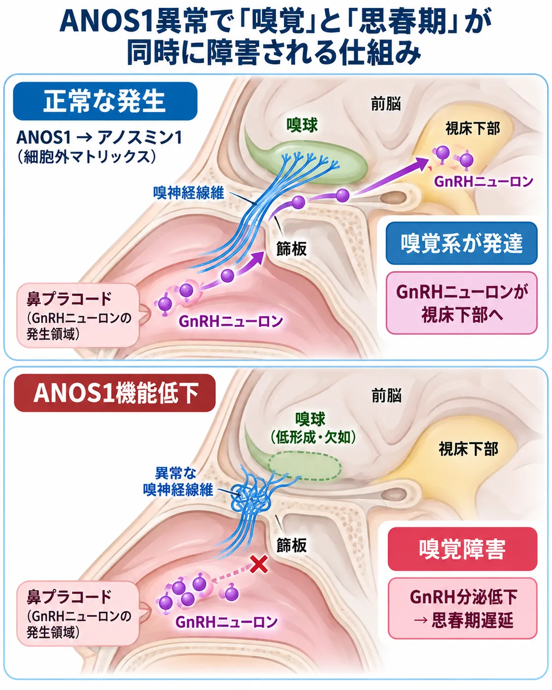 ANOS1機能低下によるカルマン症候群の発症機序―嗅覚系とGnRHニューロン遊走の障害 正常では鼻プラコードで生じたGnRHニューロンが嗅覚系の発達とともに前脳へ移動して視床下部に到達する一方、ANOS1機能低下では嗅覚系の発達とGnRHニューロンの移動が障害され、嗅覚障害と低ゴナドトロピン性性腺機能低下症につながる仕組みを比較した模式図