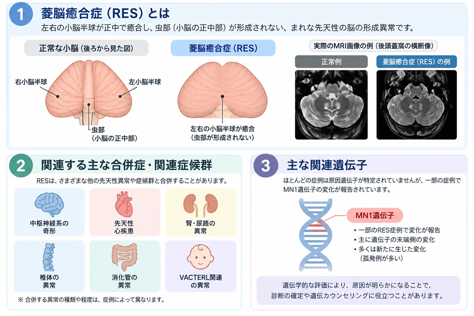 菱脳癒合症（RES）の特徴を示す模式図。正常な小脳とRESを比較し、RESでは小脳虫部が形成されず左右の小脳半球が正中で癒合すること、MRIでの見え方、関連する先天異常、MN1遺伝子との関連を示す。