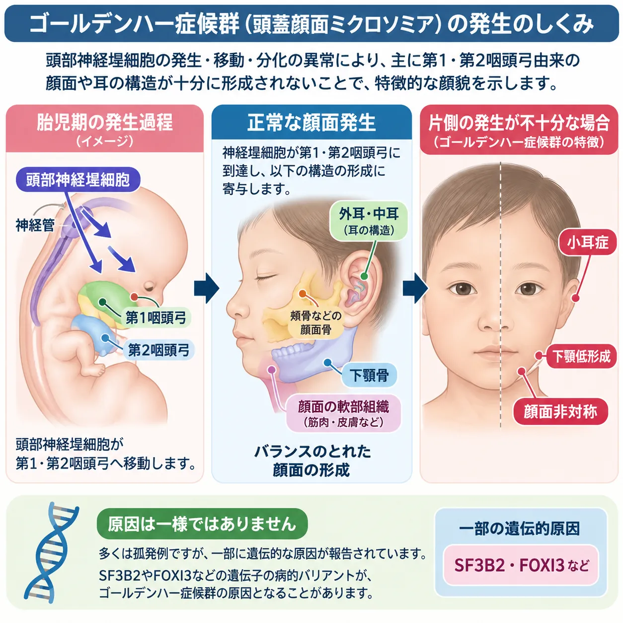 ゴールデンハー症候群でみられる顔面の左右差について、類皮腫などの眼の異常、小耳症などの耳の異常、頬骨・上顎骨の発達異常、下顎低形成、顔面軟部組織の異常を解剖学的位置とともに示した模式図