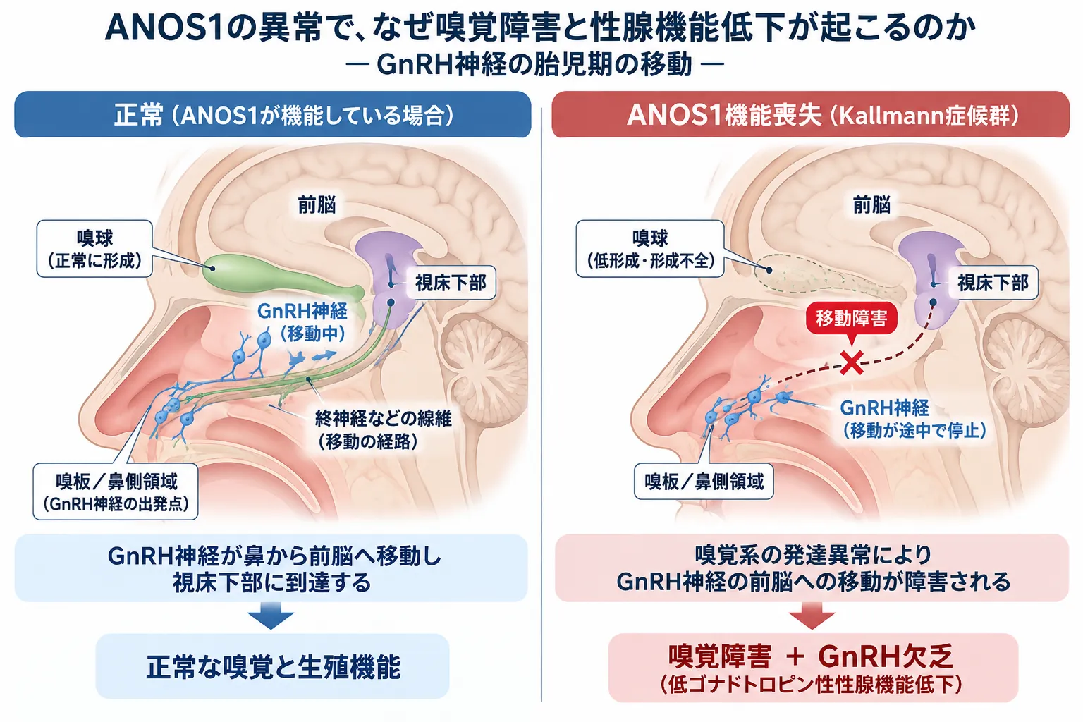 ANOS1機能喪失により嗅覚系の発達が障害され、鼻側領域から前脳・視床下部へ向かうGnRH神経の胎児期の移動が妨げられ、嗅覚障害とGnRH欠乏が生じる仕組みを正常と比較した模式図