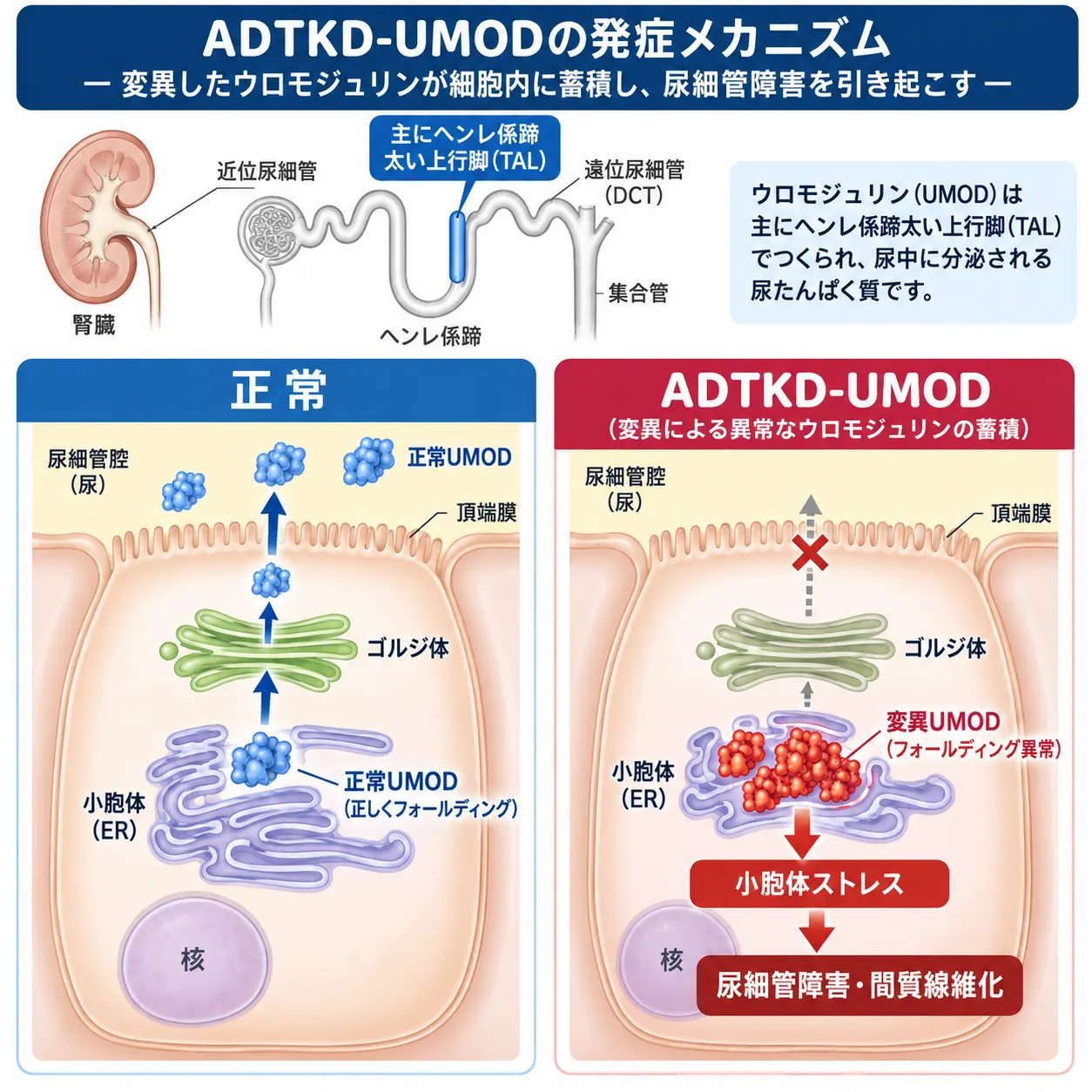 ADTKD-UMODで、正常なウロモジュリンが小胞体からゴルジ体を経て尿中へ分泌される過程と、変異ウロモジュリンが小胞体に蓄積して小胞体ストレス、尿細管障害、間質線維化を引き起こす発症機序を比較した模式図