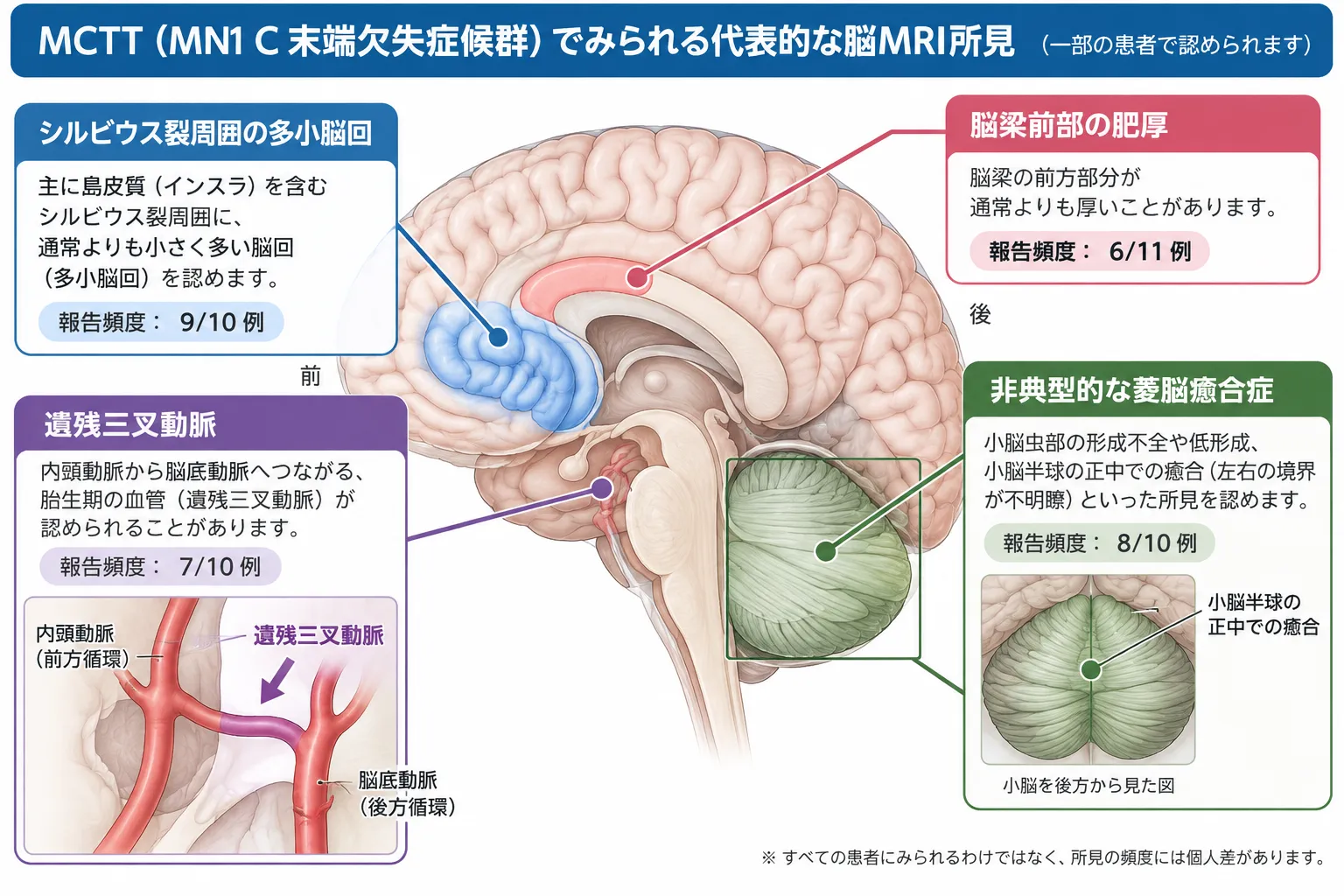 MCTT(MN1 C末端切断症候群)でみられる代表的な脳MRI所見として、シルビウス裂周囲の多小脳回、遺残三叉動脈、脳梁前部の肥厚、非典型的な菱脳癒合症を脳の位置関係とともに示した模式図