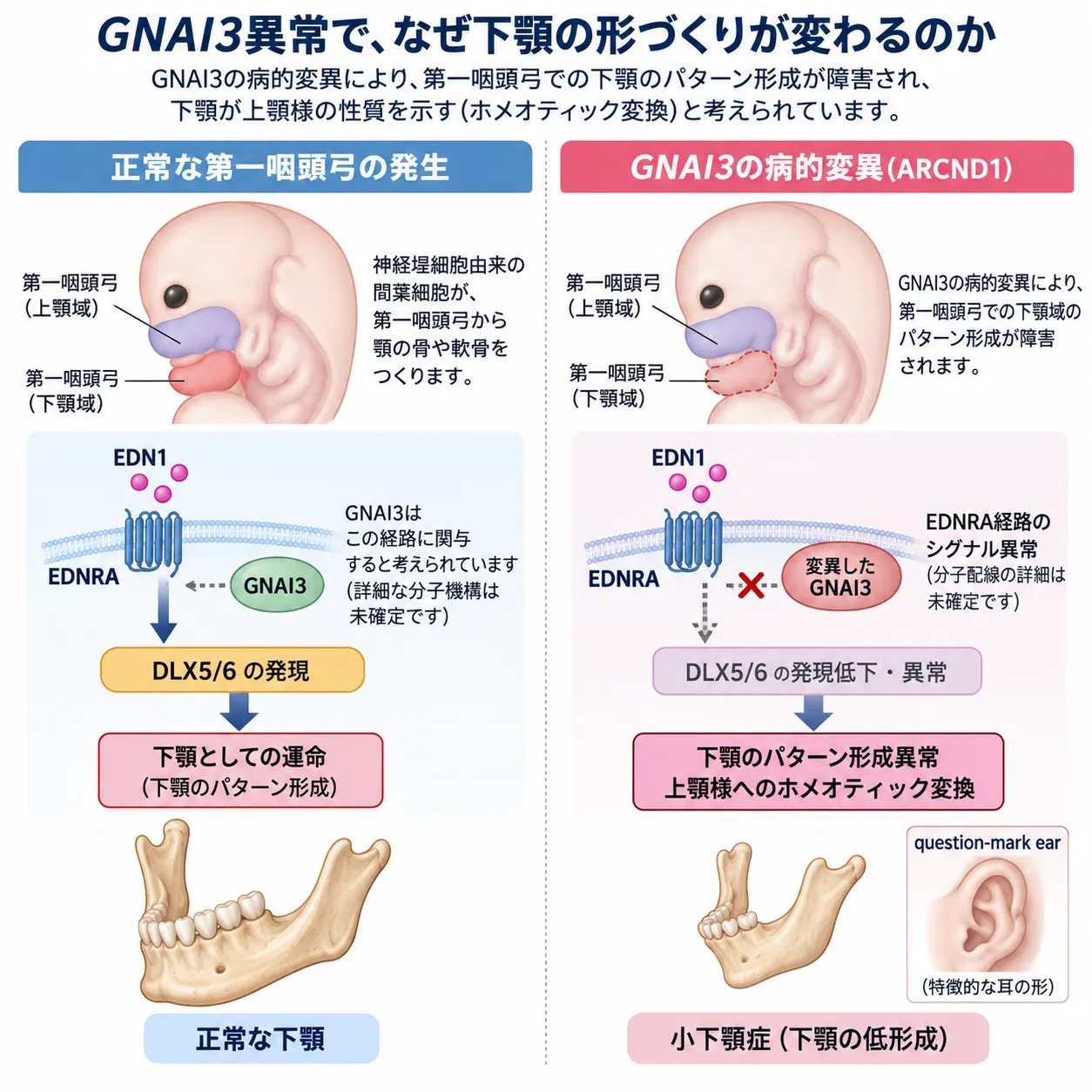 正常な第一咽頭弓ではEDN1・EDNRA経路とGNAI3が下顎のパターン形成に関与する一方、GNAI3病的変異では下顎領域の形成が障害され、耳介下顎症候群1型（ARCND1）の小下顎症やquestion-mark earにつながる仕組みを比較した模式図