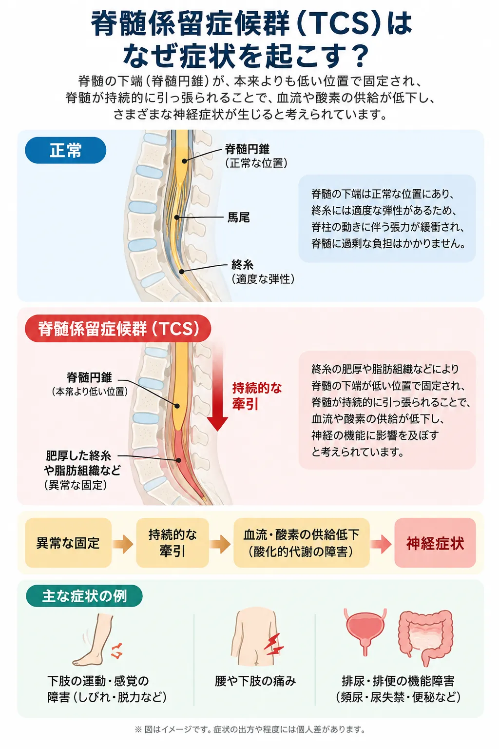 脊髄係留症候群（TCS）の病態を示す模式図。正常な脊髄とTCSを比較し、終糸肥厚や脂肪組織などによる異常な固定から、持続的な牽引、血流・酸素供給低下、酸化的代謝障害を経て、下肢の運動・感覚障害、腰や下肢の痛み、排尿・排便機能障害につながる流れを示す。