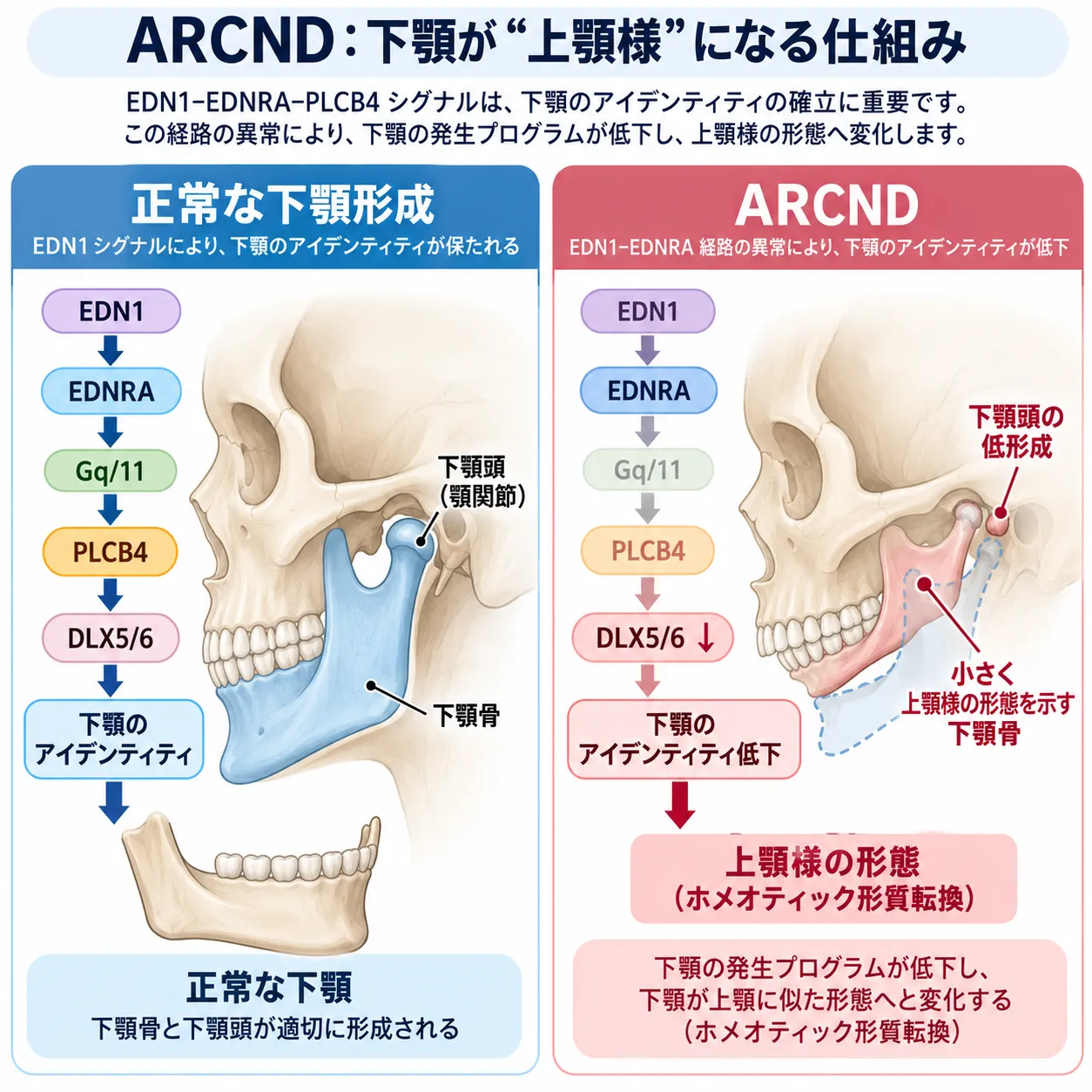 耳介下顎症候群(ARCND)におけるEDN1–EDNRA–Gq/11–PLCB4経路と下顎のホメオティック形質転換 正常ではEDN1がEDNRAに結合しGq/11・PLCB4を介してDLX5/6を活性化して下顎のアイデンティティを確立する一方、耳介下顎症候群(ARCND)ではこのシグナル経路の異常により下顎頭の低形成と下顎の上顎様形態へのホメオティック形質転換が生じる仕組みを比較した模式図