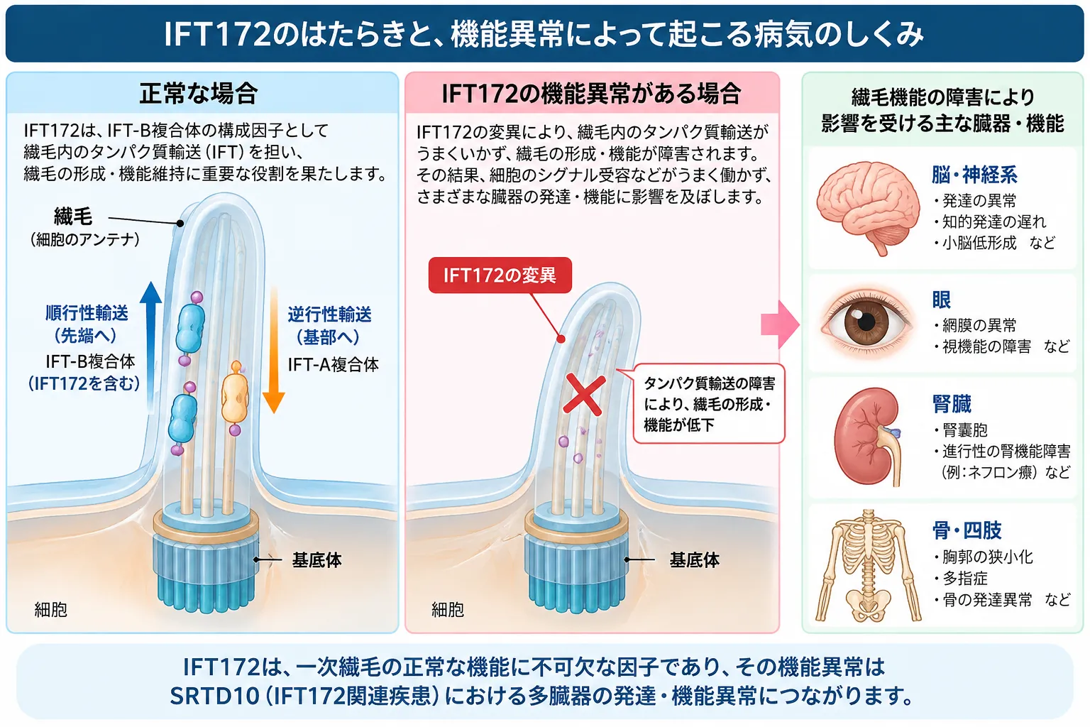 IFT172がIFT-B複合体の構成因子として一次繊毛内輸送に関与し、ヘッジホッグシグナル伝達を支える正常な状態と、IFT172機能低下による繊毛機能障害が網膜・脳・腎臓・骨格などの異常につながるSRTD10の発症機序を示す模式図