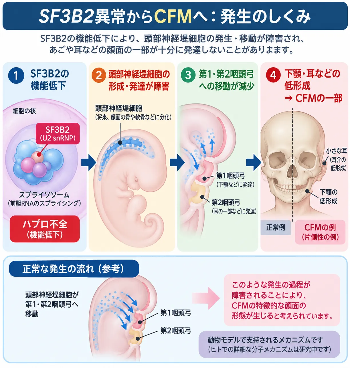SF3B2の機能低下によりスプライシングが障害され、頭部神経堤細胞の発生・移動の異常を介して第一・第二咽頭弓由来の下顎や耳の低形成につながる頭蓋顔面ミクロソミア(CFM)の発症機序を示す模式図