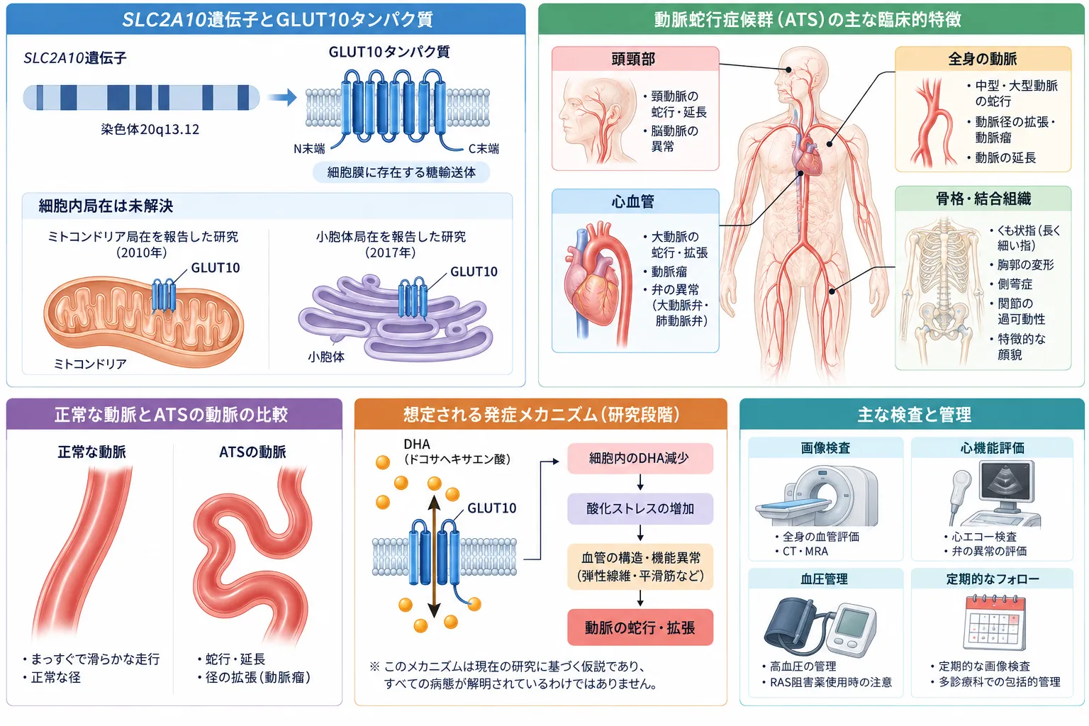 SLC2A10遺伝子とGLUT10タンパク質の働き、動脈蛇行症候群（ATS）の血管蛇行・臨床的特徴、DHA輸送と酸化ストレスを介する発症機序、検査と管理を示す医学図