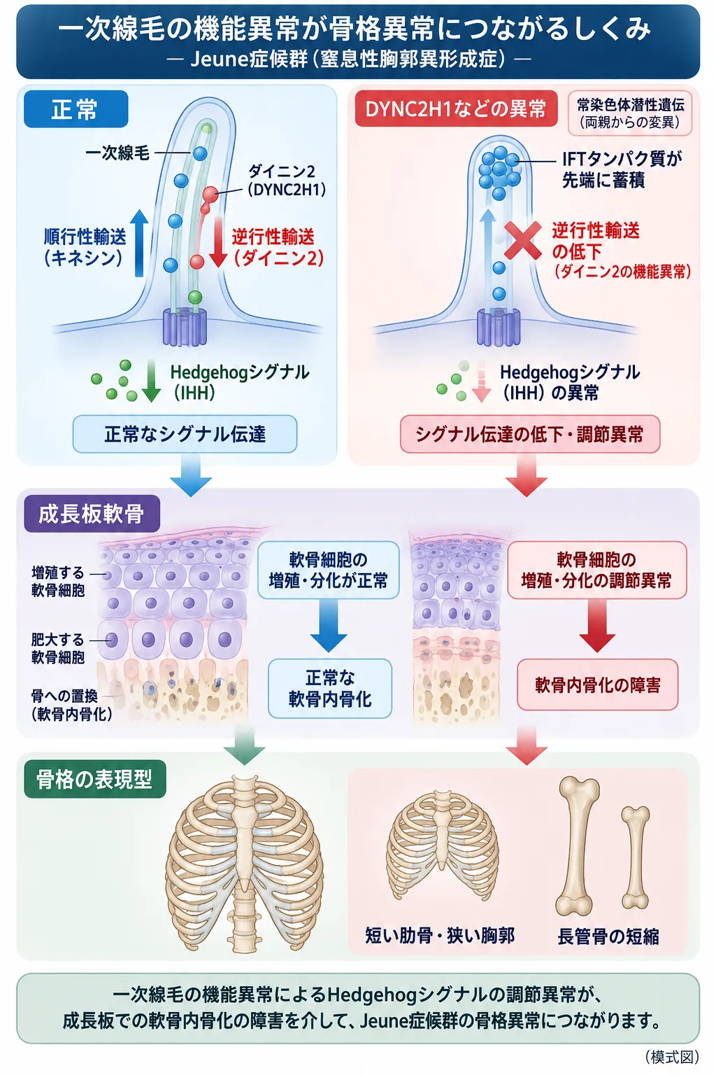 Jeune症候群でDYNC2H1などの異常により一次線毛の逆行性輸送とHedgehogシグナルが障害され、成長板の軟骨内骨化異常から短い肋骨・狭い胸郭・長管骨短縮につながる仕組みを示す模式図