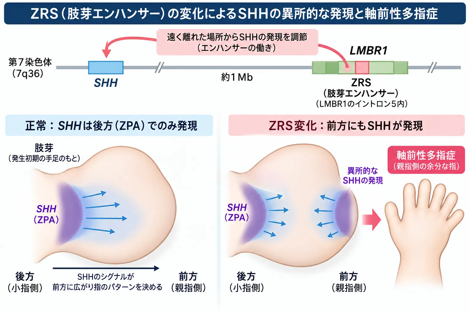 ZRS（肢芽エンハンサー）の変化によってSHHが肢芽前方にも異所性発現し、親指側に余分な指が生じる軸前性多指症の発症機序を、正常なSHH発現と比較した模式図