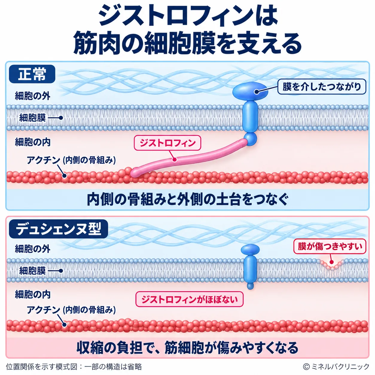 正常な筋細胞ではジストロフィンが細胞内のアクチンと膜のタンパク質をつなぐ一方、デュシェンヌ型ではジストロフィンがほぼなく、細胞膜が傷つきやすくなることを示す模式図