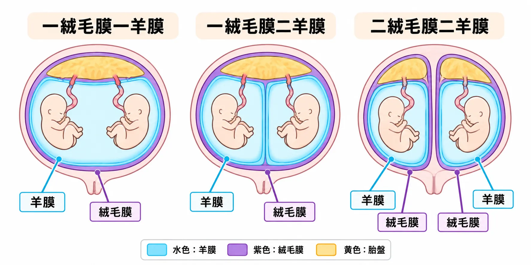 双胎の膜性の模式図(一絨毛膜一羊膜・一絨毛膜二羊膜・二絨毛膜二羊膜の胎盤と羊膜の数)