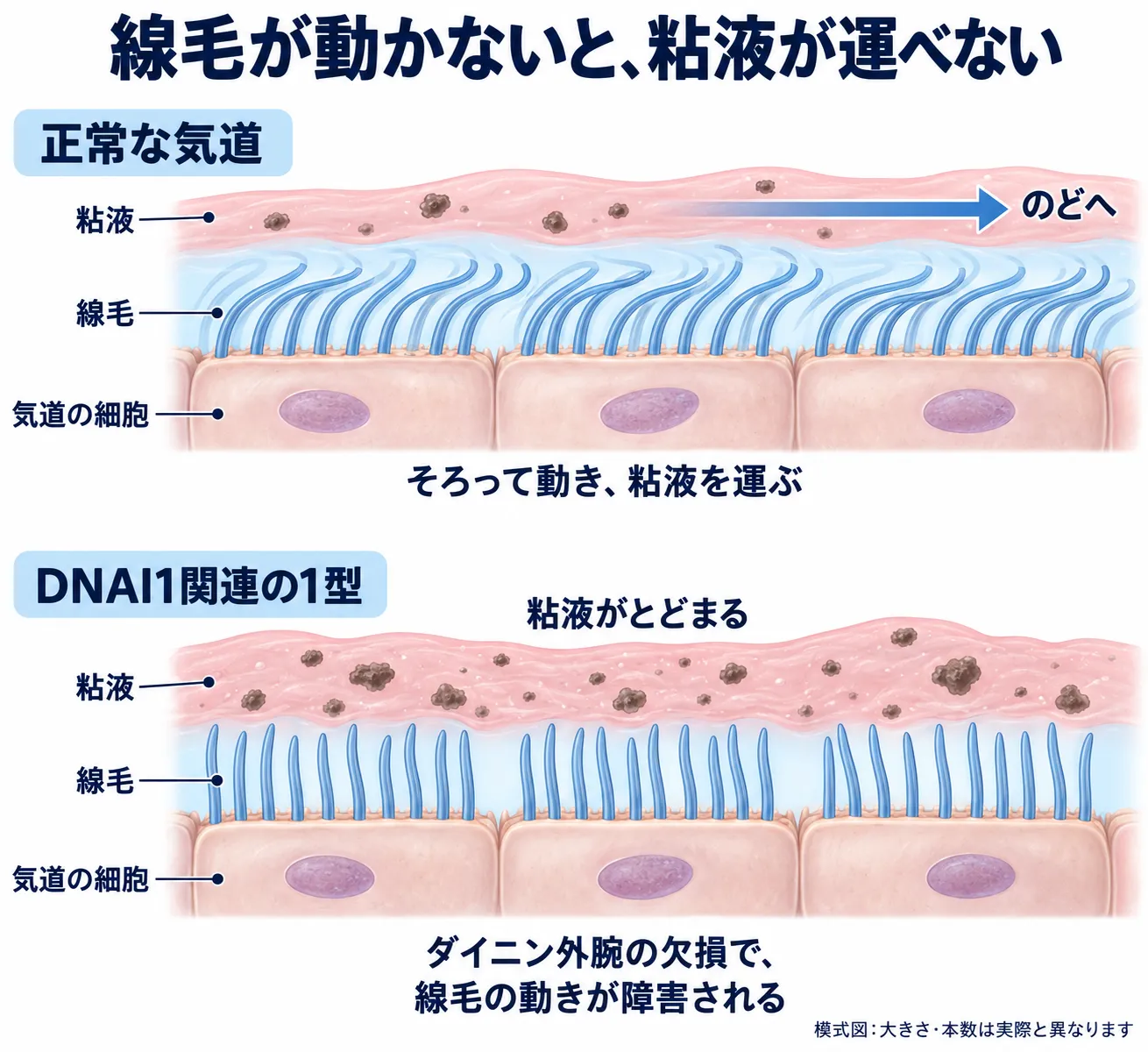 DNAI1関連の原発性線毛機能不全症1型と気道の粘液輸送 正常な気道では線毛の協調した動きが粘液をのどへ運ぶ一方、DNAI1関連の原発性線毛機能不全症1型では線毛の運動が障害され、粘液がとどまる様子を比較した模式図