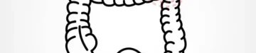 大腸がんのイメージイラスト
