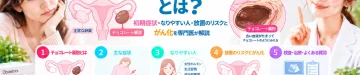 チョコレート嚢胞とは何か、初期症状やなりやすい人の特徴、放置した場合のリスクとがん化の可能性を専門医が解説する記事のアイキャッチ