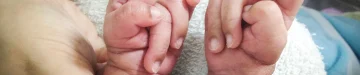指を重ね合わせて握り締めるのが、エドワーズ症候群(18トリソミー)の特徴です。