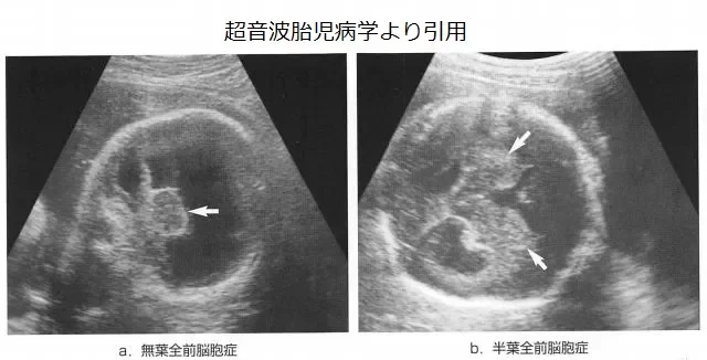 全前脳胞症