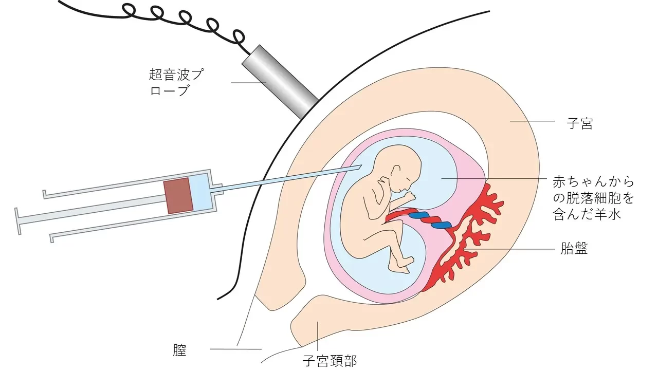 羊水検査イメージイラスト