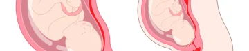 常位胎盤早期剥離