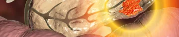 すい臓がんのイメージ画像