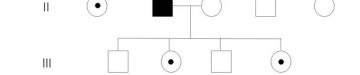 X連鎖劣性疾患の家系図例